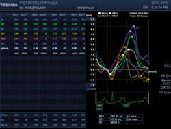 Bildschirmaufnahme einer Speckle-Tracking-Auswertung